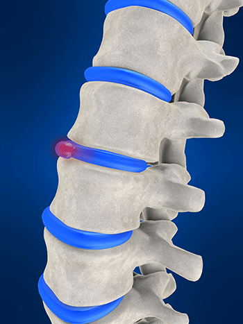 Risk of Disc Herniation Decreases After Age 80